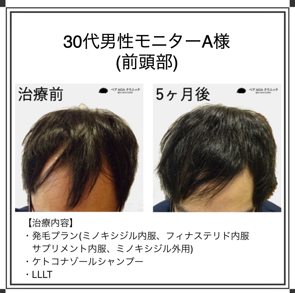 東京新宿で薄毛治療ならベアagaクリニックがおすすめです