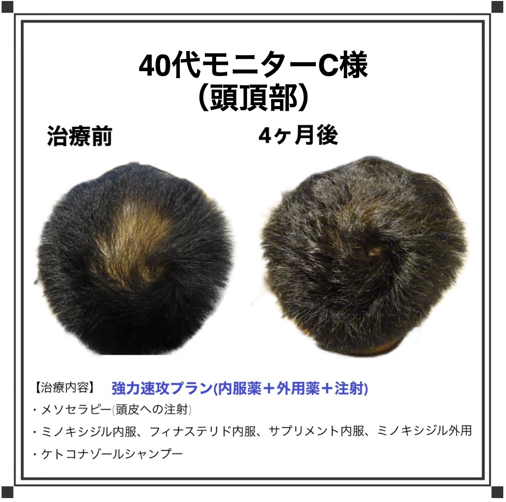 ベアAGAクリニック｜新宿で薄毛治療なら当クリニックがおすすめです