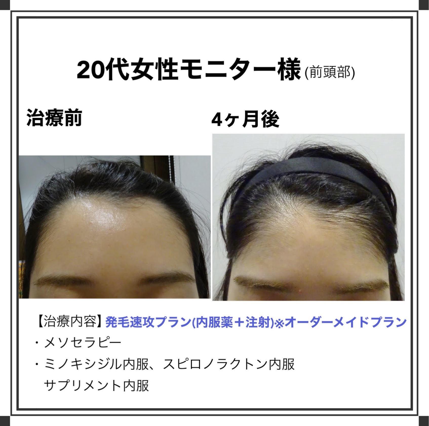 東京新宿で薄毛治療ならベアagaクリニックがおすすめです