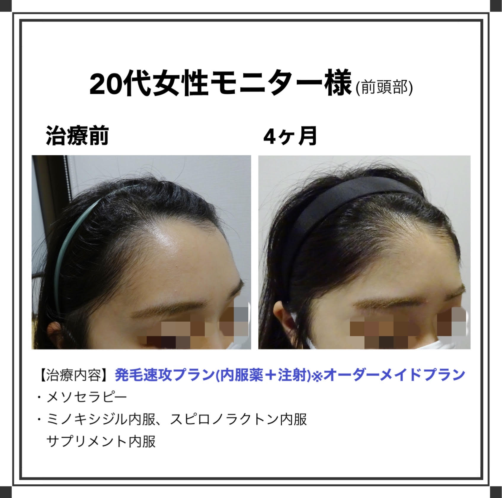 ベアagaクリニック 新宿で薄毛治療なら当クリニックがおすすめです