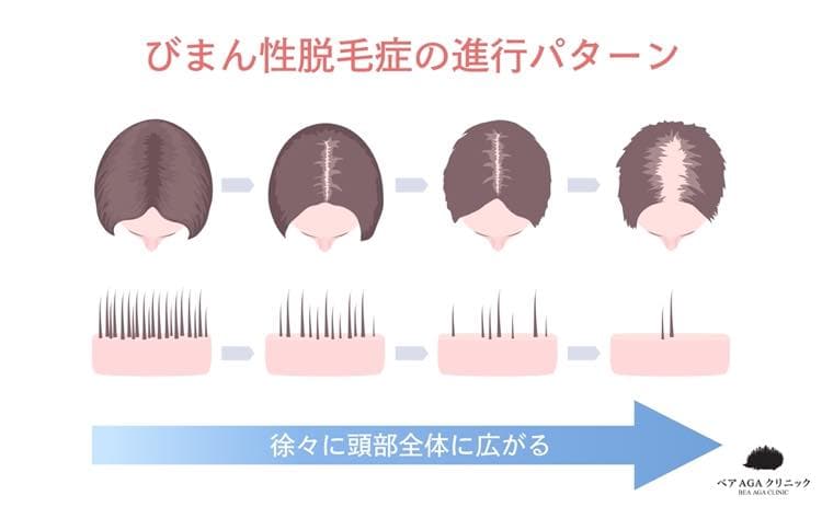 びまん性脱毛症の進行パターン