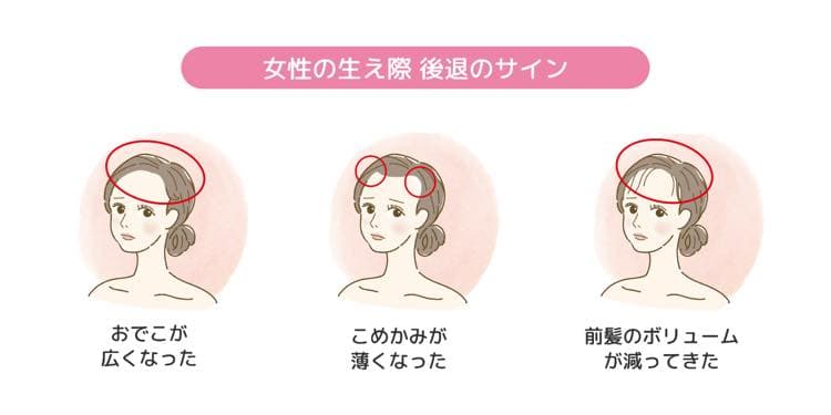 女性の生え際　後退のサイン