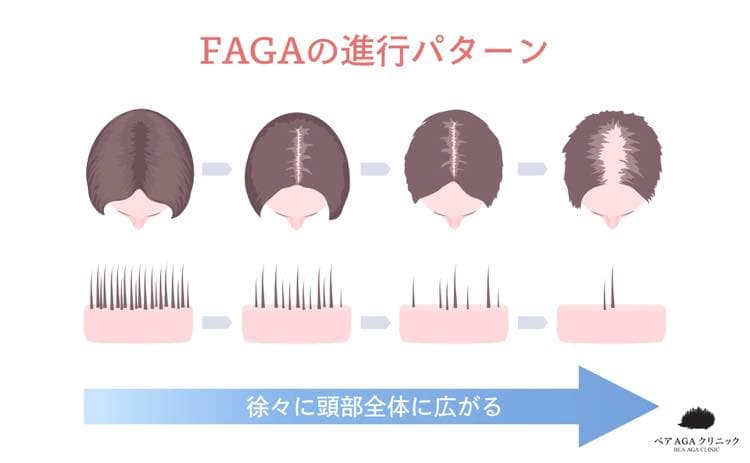 FAGAの進行パターン