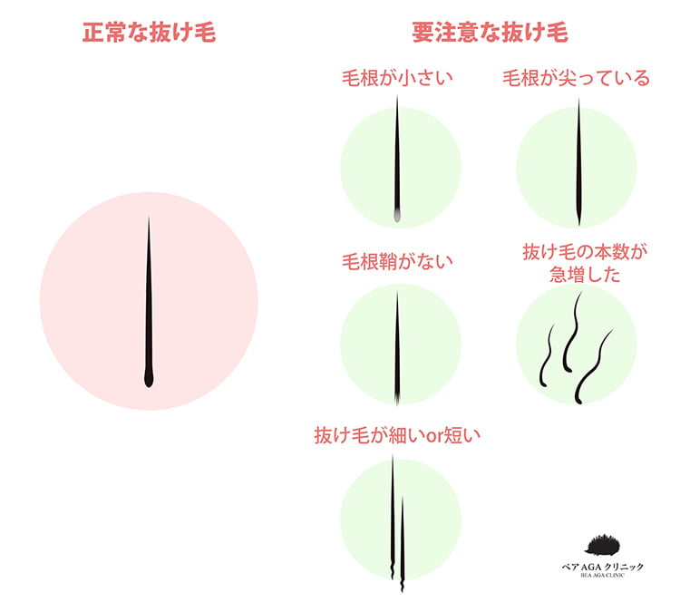 正常な抜け毛と要注意な抜け毛　イメージ画像