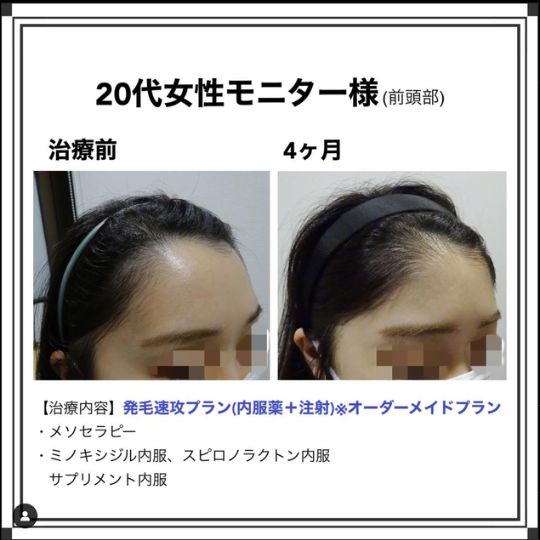 体験談 20代女性 前頭部
