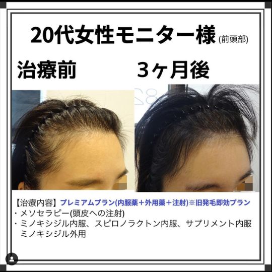 体験談 20代女性 前頭部 2