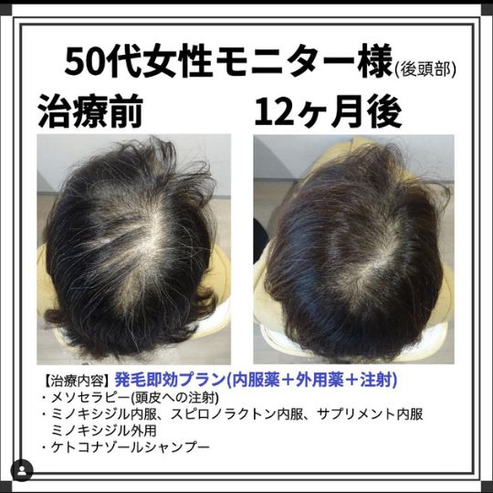体験談 30代女性 後頭部