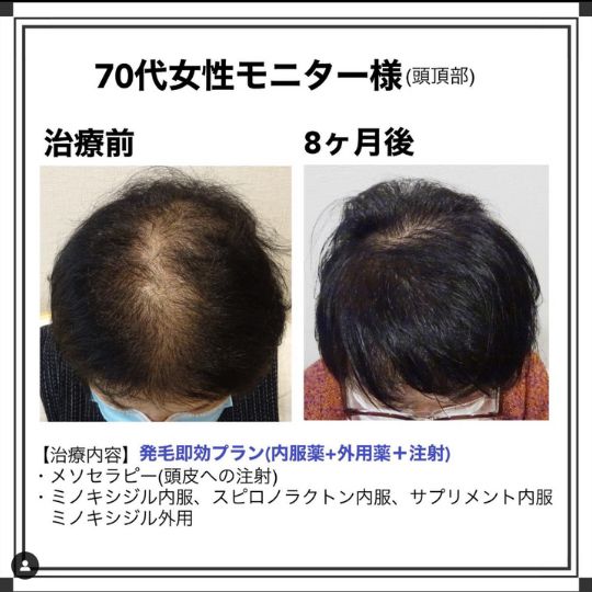 体験談 70代女性 頭頂部