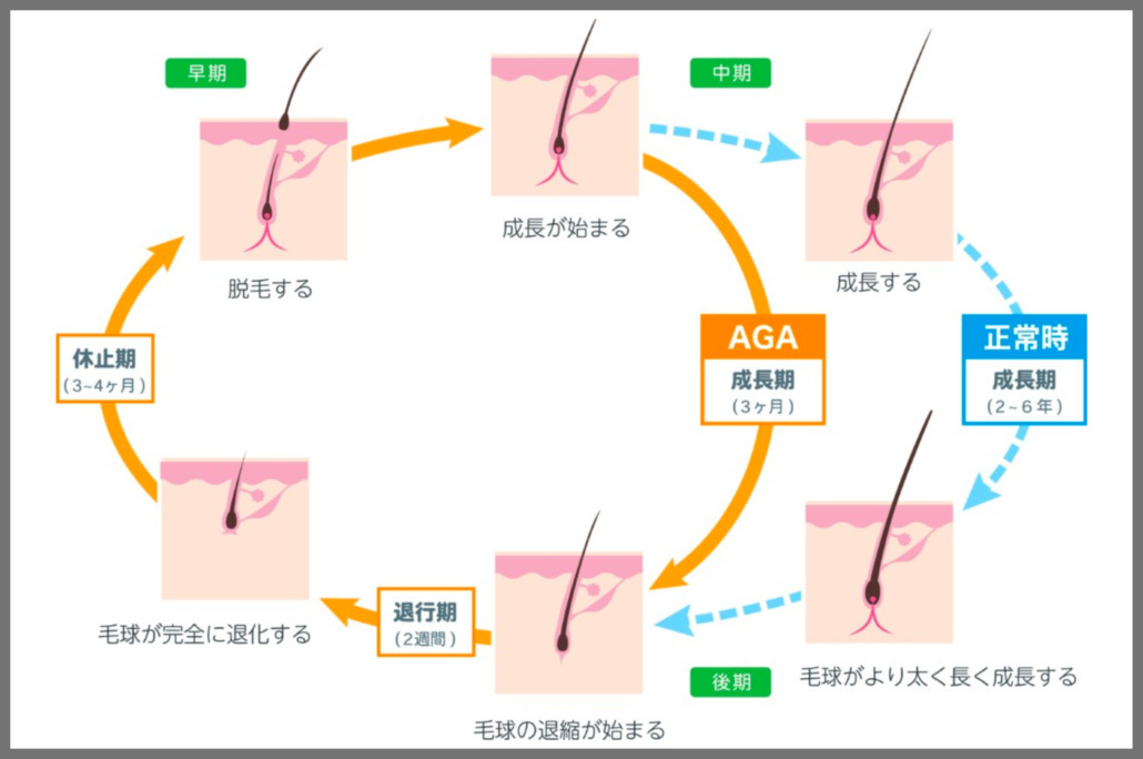 AGAを引き起こす原因